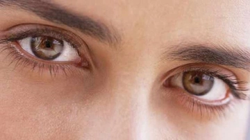 Zehirli Guatr Göz Büyümesi Belirtileri ve Tedavisi