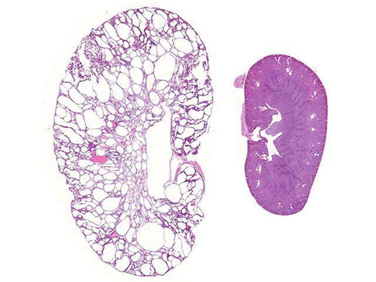 Böbrek Büyümesi Belirtileri ve Tedavisi