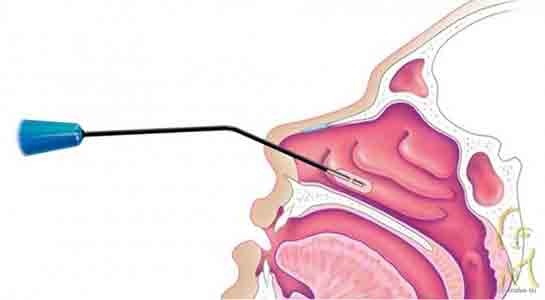 Burun Eti Büyümesi Ameliyatı Riskleri ve Sonrası
