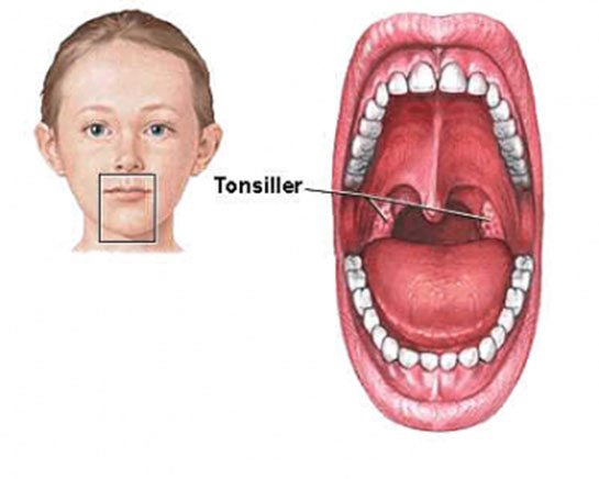 Çoçuklarda Geniz Eti Büyümesi Belirtileri ve Tedavisi
