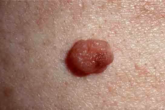 Et Beni Büyümesi Belirtileri ve Tedavisi