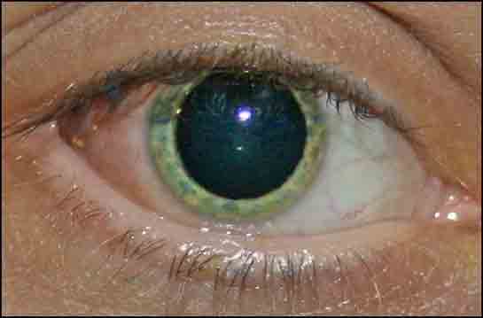 Göz Bebeğinin Büyümesi Belirtileri ve Tedavisi