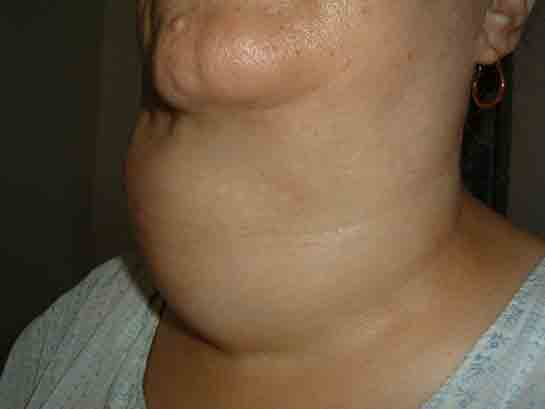 Guatr Büyümesi Belirtileri ve Tedavisi