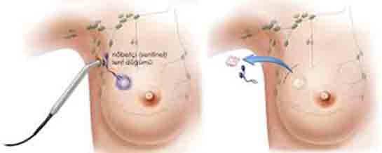 Lenf Bezi Büyümesi Belirtileri ve Tedavisi